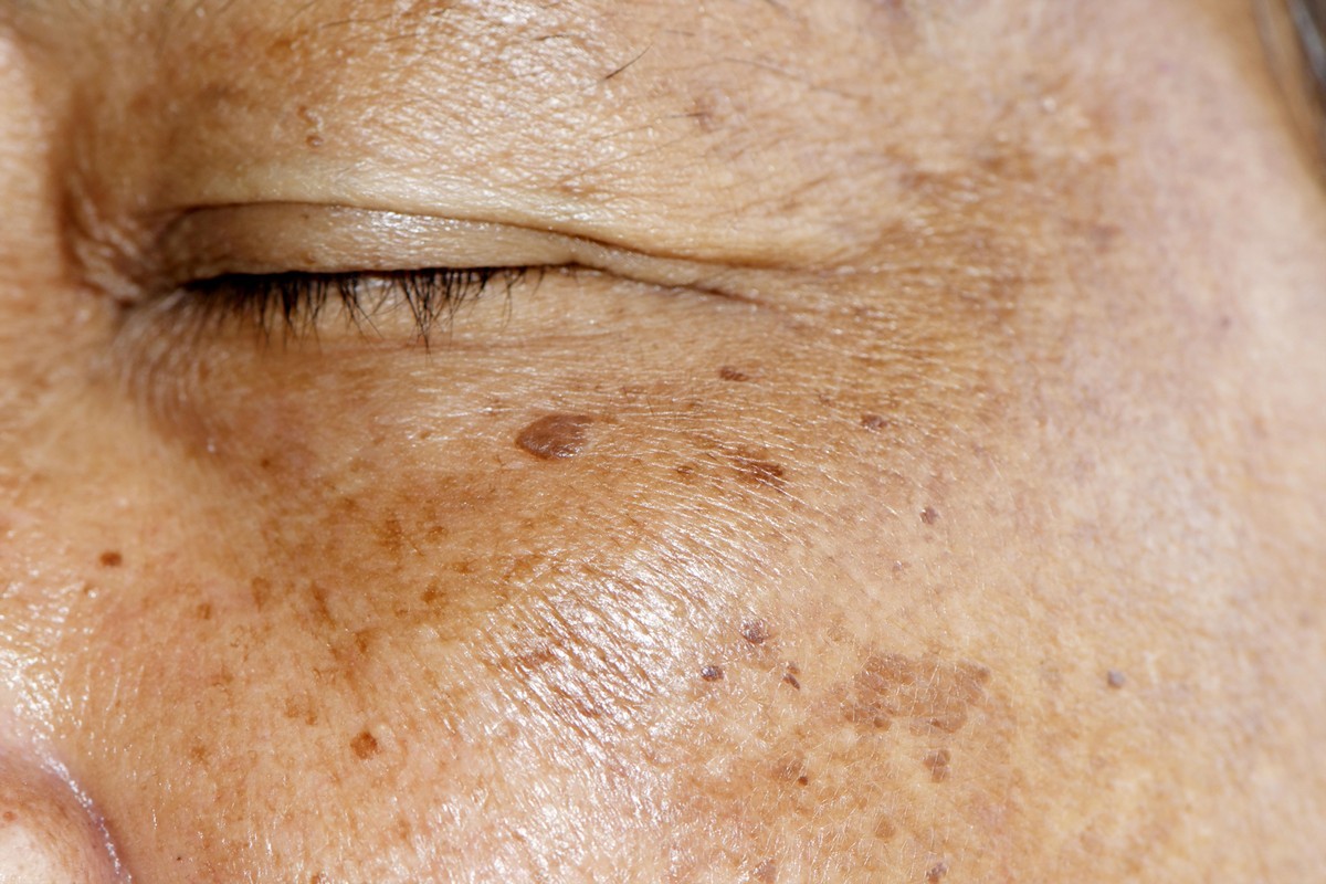 Age Spots - Brown Spots