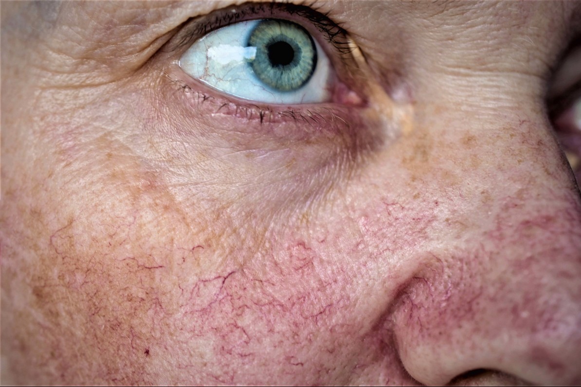 Rosacea