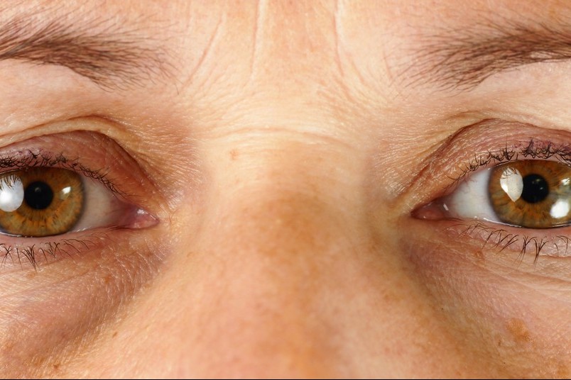 Wrinkle Treatments